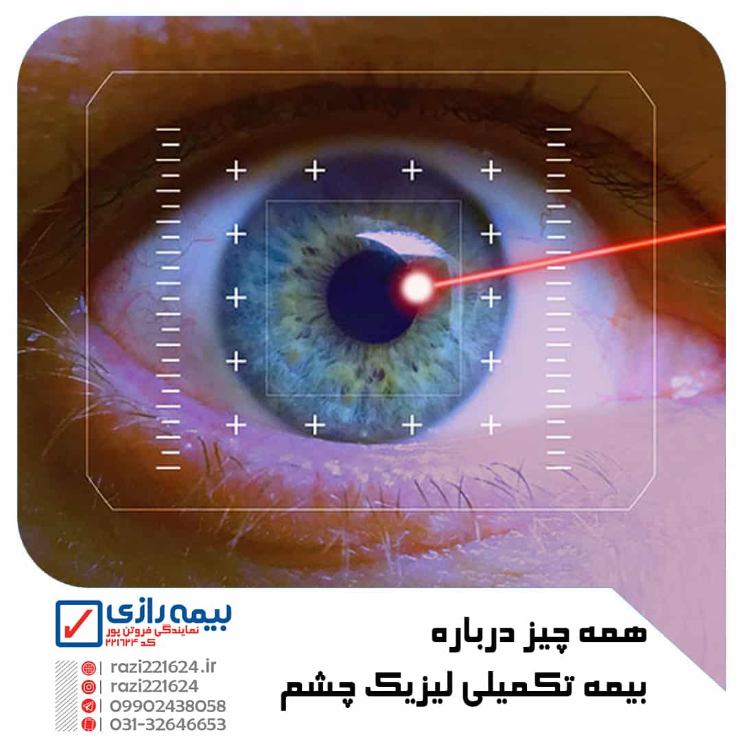 عمل لیزیک چشم